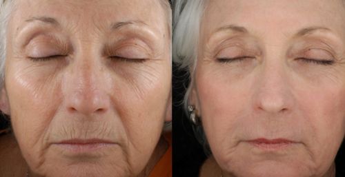 Customer photo review of Dermasoie Masque-Sérum Nuit Liftant