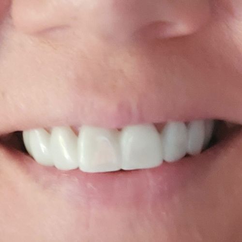 Customer photo review of Tooth-Veneer 2.0