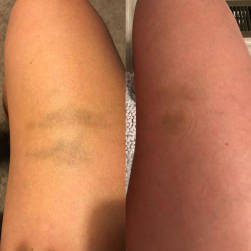 Customer photo review of VaricoseCure™ Varicose Removal Cream