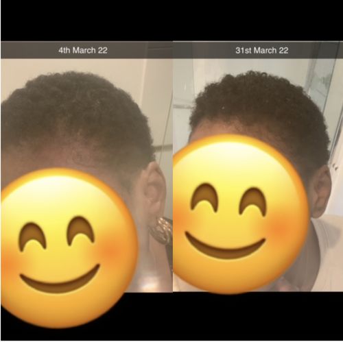 Customer photo review of Grow Pro: Derma Roller for Hair & Beard
