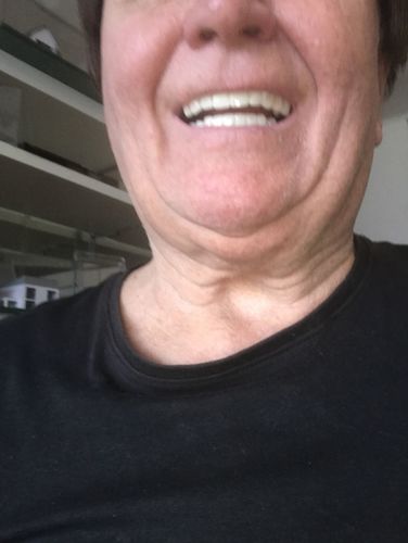 Customer photo review of Teeth-Veneer 2.0