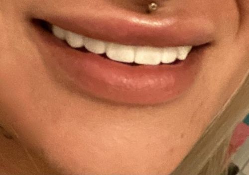 Customer photo review of Teeth-Veneer 2.0