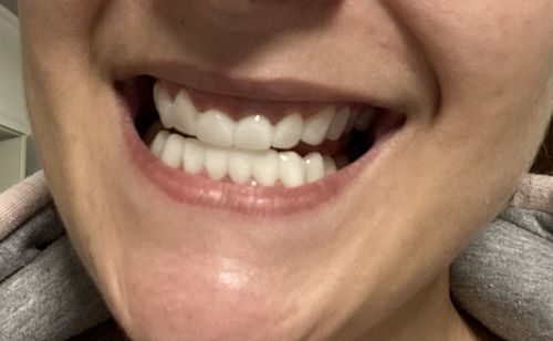 Customer photo review of Teeth-Veneer 2.0