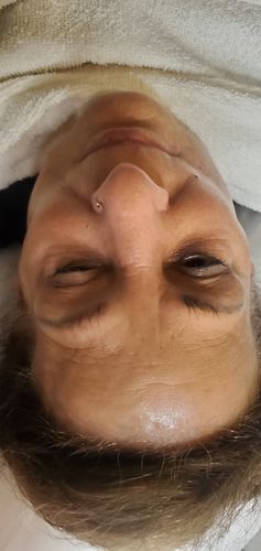 Customer photo review of Super Micro Bubble Blackhead Remover