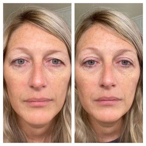 Customer photo review of DrömskStil™ Osynlig Ögonlockstejp