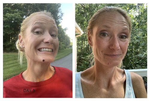 Customer photo review of Boldtique™ Organic Skin Tag Remover