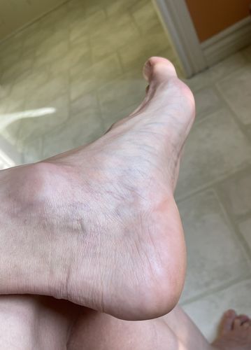 Customer photo review of Shea Foot Repair Cream