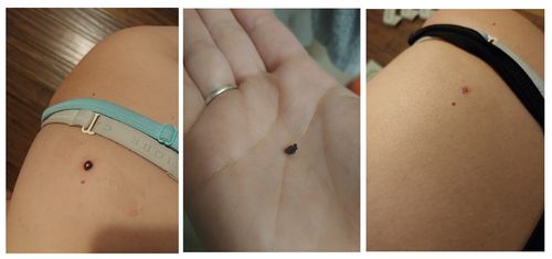 Customer photo review of Boldtique™ Organic Skin Tag Remover