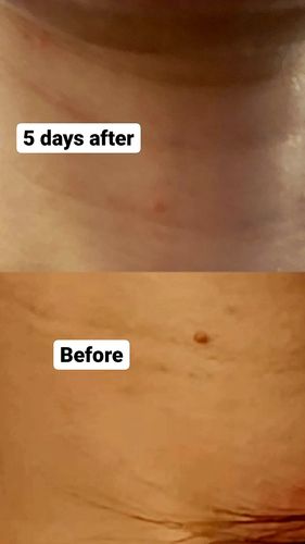 Customer photo review of Dermavel - Fibroblast Plasma Pen