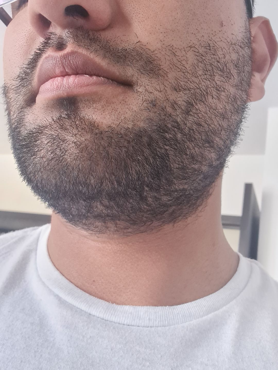 Customer photo review of Kit Adiós Alopecia