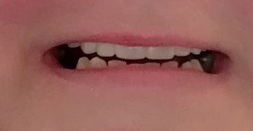 Customer photo review of Teeth-Veneer 2.0