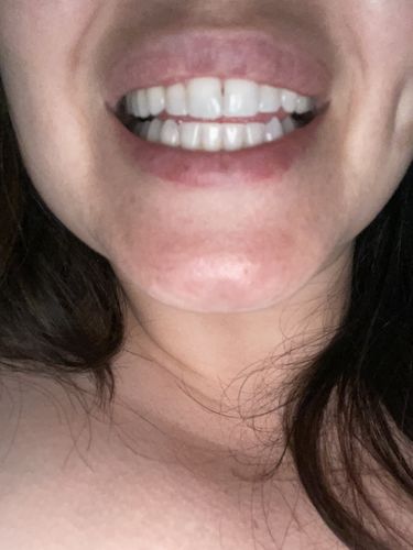 Customer photo review of Fusion 2-in-1 Whitening Gel