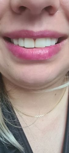 Customer photo review of Teeth-Veneer 2.0