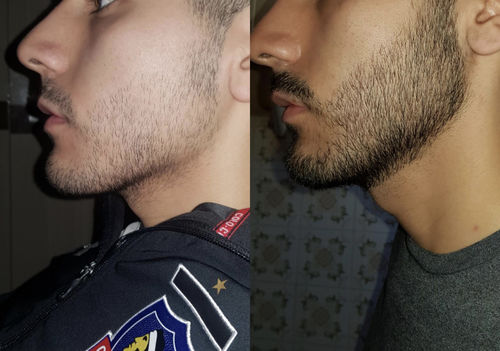 Customer photo review of Bálsamo para Crecimiento de Barba y Bigote Extra Fuerte Minoxidil 15% 100 ml