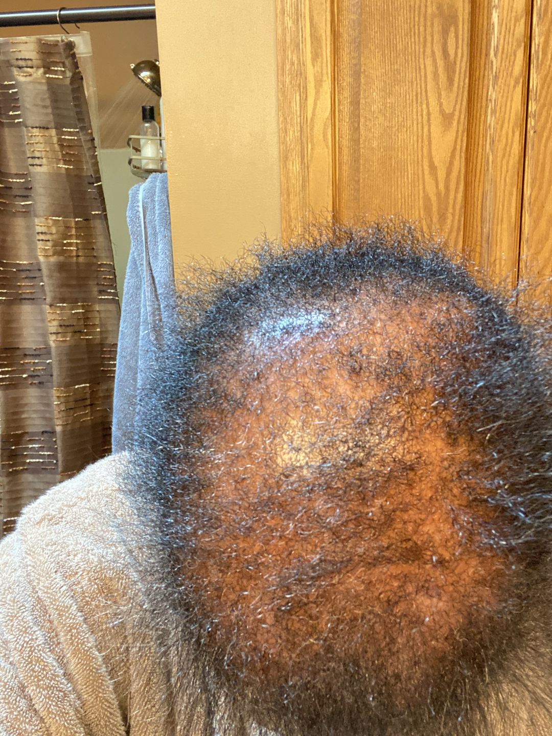 Customer photo review of Super G  Vital Growth Serum Water-based scalp serum infused with white willow bark