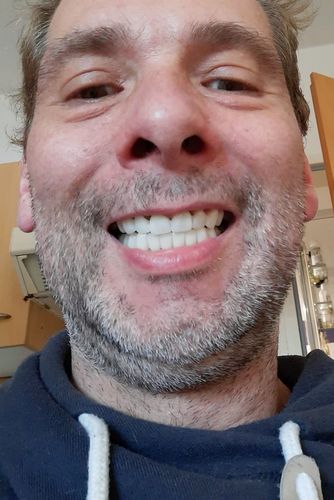 Customer photo review of Teeth-Veneer 2.0