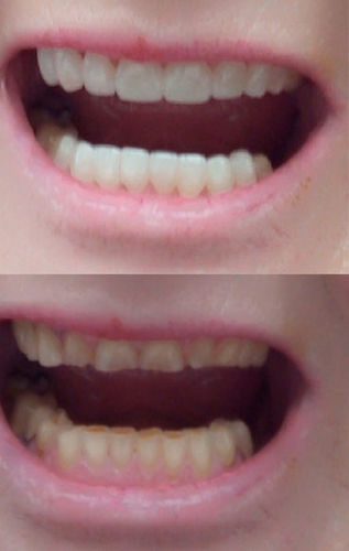 Customer photo review of Teeth-Veneer 2.0