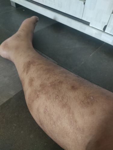 Customer photo review of Original Eczema Cream