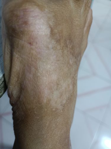 Customer photo review of Original Eczema Cream