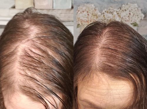 Customer photo review of Boldtique™ Japanskt Risvatten-Serum för Hårväxt