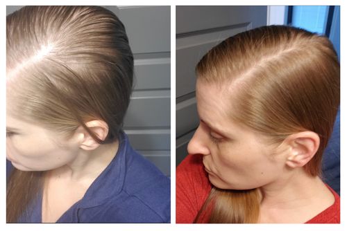 Customer photo review of Boldtique™ Japanskt Risvatten-Serum för Hårväxt