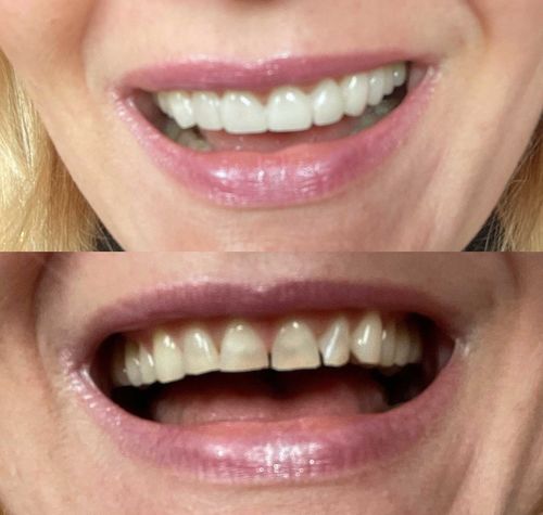 Customer photo review of Teeth-Veneer 2.0
