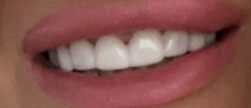 Customer photo review of Teeth-Veneer 2.0