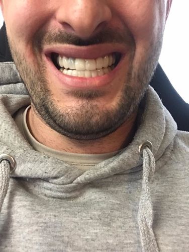 Customer photo review of Teeth-Veneer 2.0