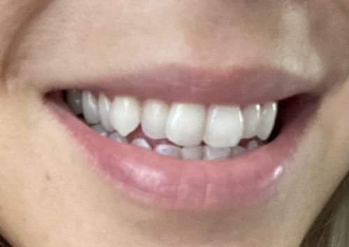 Customer photo review of bedrō Whitening