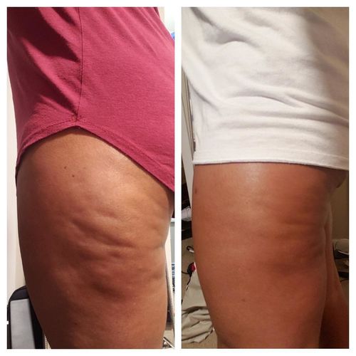 Customer photo review of Boldtique™ Hudåtstramning Spray