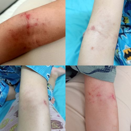 Customer photo review of Eczema Treatment Set