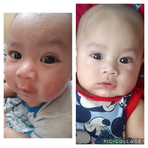 Customer photo review of Baby Eczema Cream