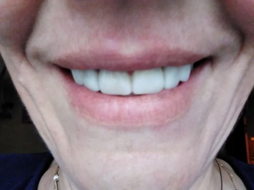Customer photo review of Teeth-Veneer 2.0