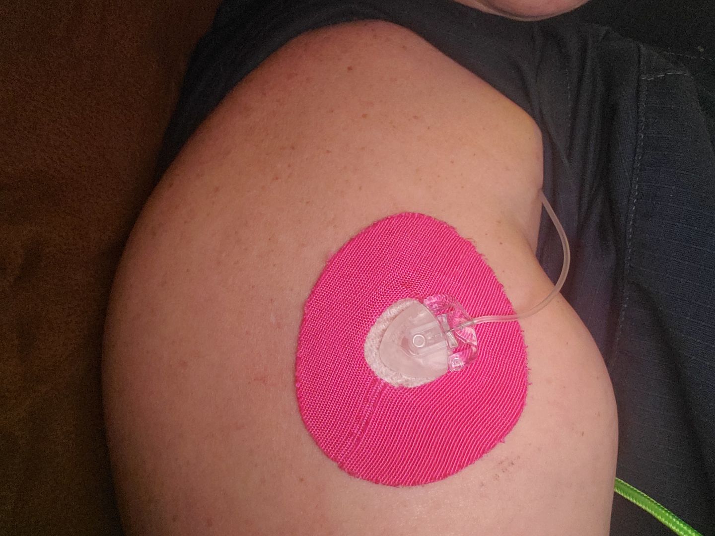 Customer photo review of Skin Grip Universal Adhesive Patches (0.8 inch Hole)
