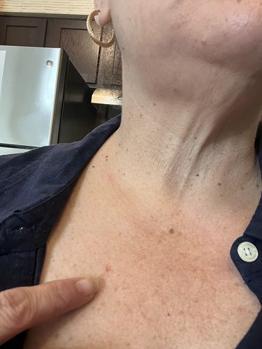 Customer photo review of AutoFlik™ Snabb & Smärtfri Hudfliksborttagning