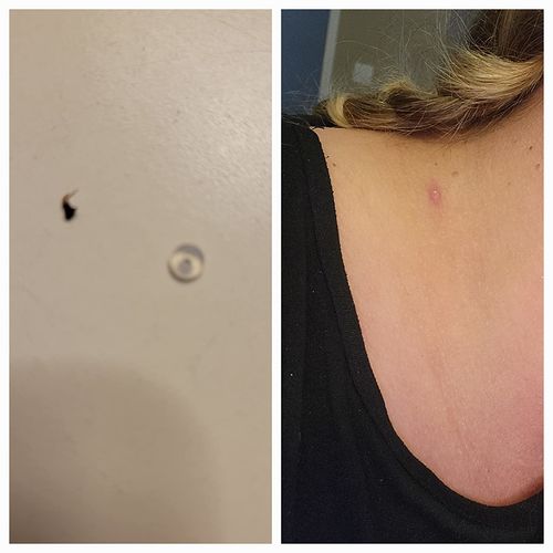 Customer photo review of AutoFlik™ Snabb & Smärtfri Hudfliksborttagning