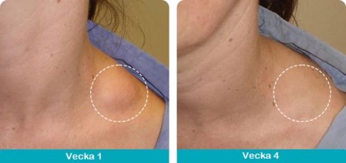 Customer photo review of Mandalashley™ Lymfatisk Dräneringspenna