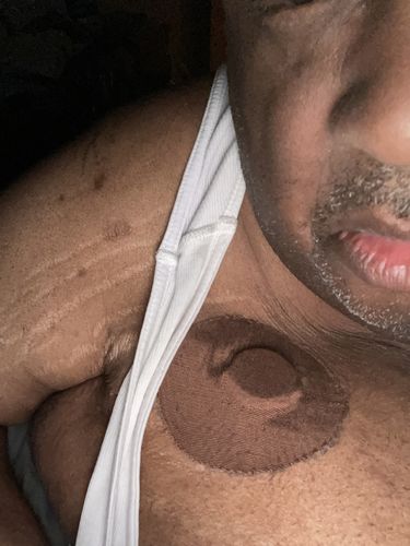 Customer photo review of Skin Grip Medtronic Guardian/Enlite/Libre Adhesive Patches