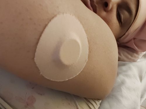 Customer photo review of Skin Grip Freestyle Libre Adhesive Patches
