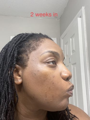 Customer photo review of BERRI-CLEAR+ 5 BERRY SUPERFRUIT SERUM