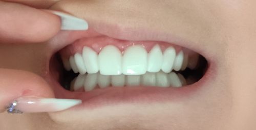 Customer photo review of Teeth-Veneer 2.0