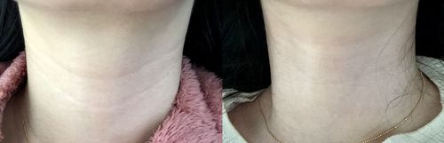Customer photo review of StoppaRynkor™ Återanvändbar Antirynkkudde