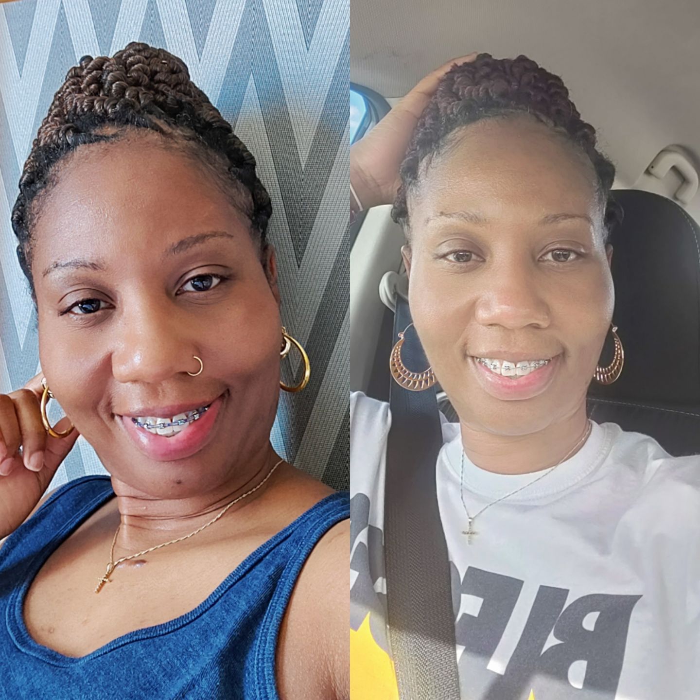 Customer photo review of Bolden Clear Skin Kit