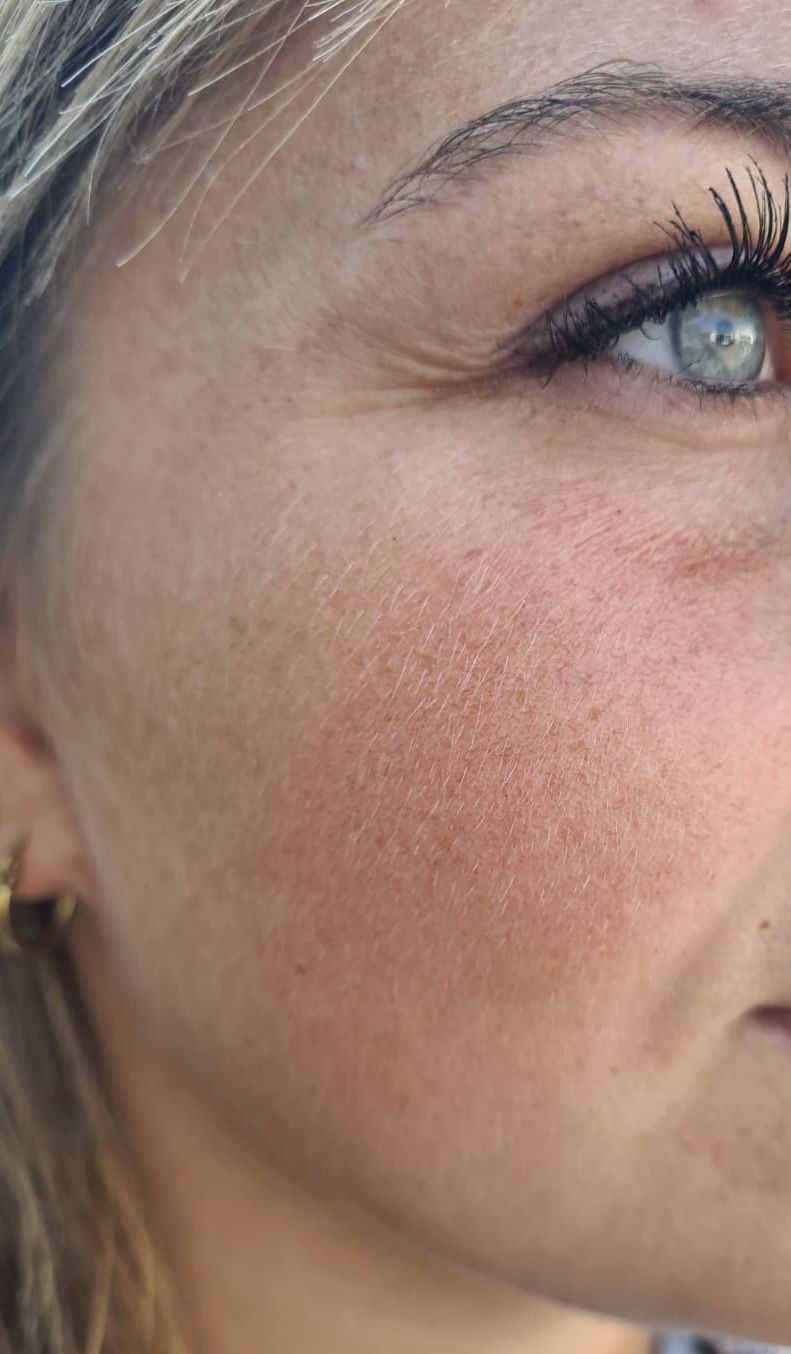 Customer photo review of Salicylsäure BHA 2% 50 ml