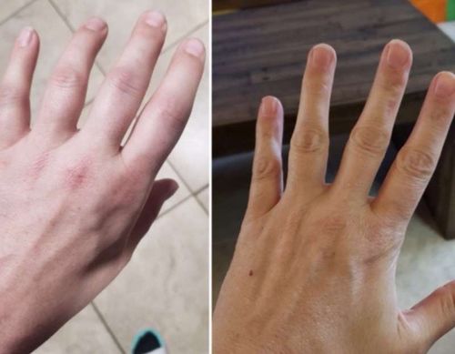 Customer photo review of Magnetic Lymphatic Drainage Therapeutic Ring