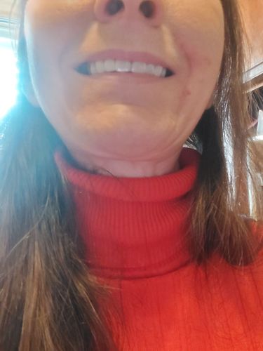 Customer photo review of Teeth-Veneer 2.0