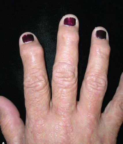 Customer photo review of Magnetic Lymphatic Drainage Therapeutic Ring