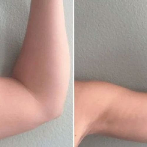 Customer photo review of Magnetic Lymph Detox Bracelet（Limited time discount 🔥 last day）