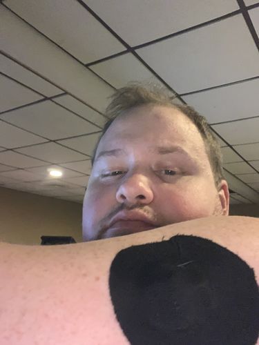 Customer photo review of Skin Grip Medtronic Guardian/Enlite/Libre Adhesive Patches