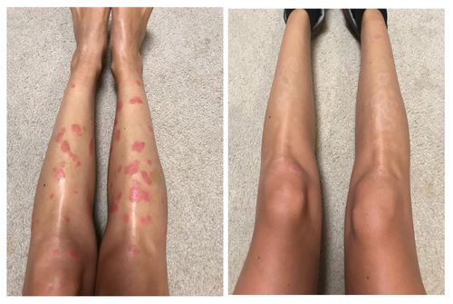 Customer photo review of BotemedelsKräm™ Psoriasis & Eksem Naturlig Kräm